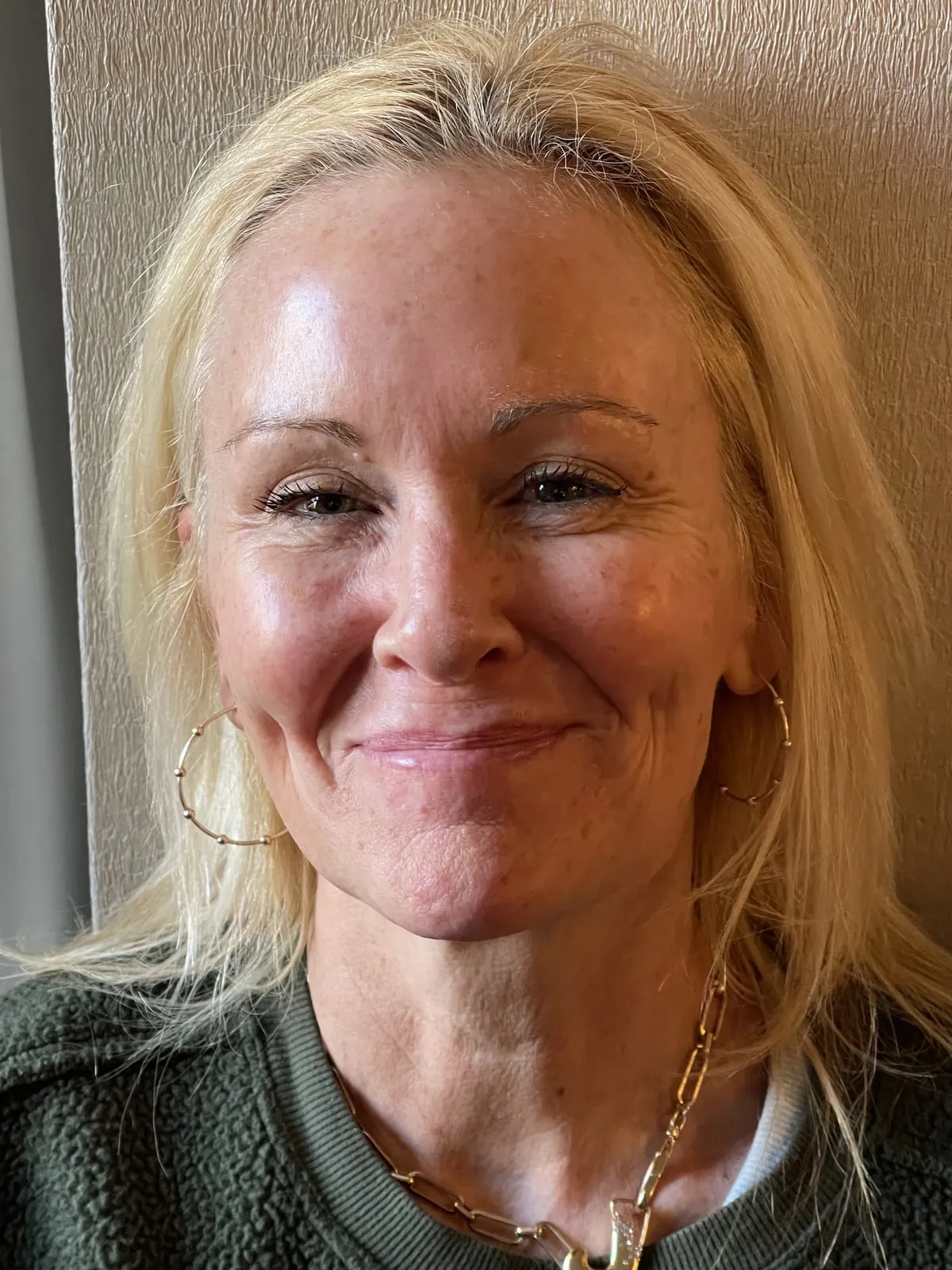 Client before filler treatment
